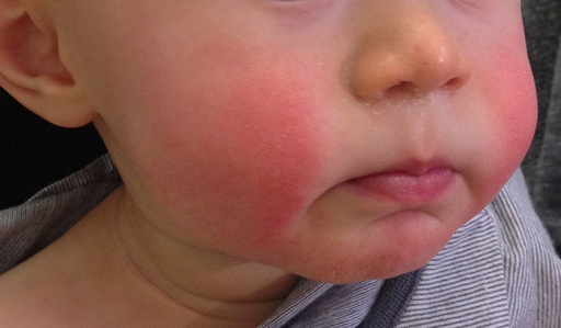 barn med utslag på kinderna orsakat av femtesjukan eller "slapped cheek syndrom"