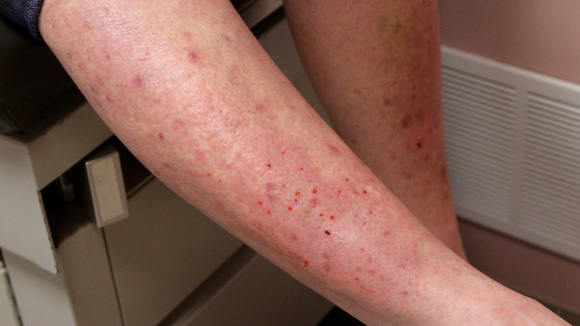 Blåsdermatoser Dermatitis herpetiformis Praktisk Medicin