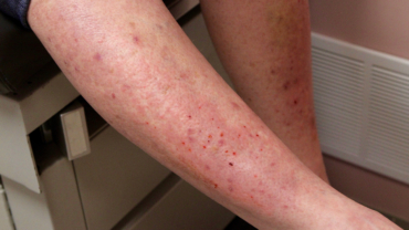 Rödlila erytem och excoriationer, Dermatitis herpetiformis på ett ben