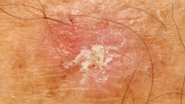 Rodnad och hyperkeratos på hud orsakat av aktinisk keratos