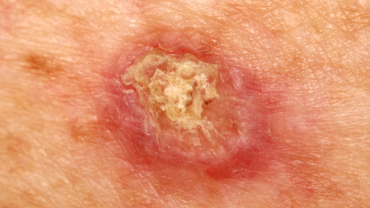 Rodnad och hyperkeratos på hud orsakat av skivepitelcancer