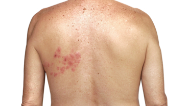Ensidig rodnad inom dermatom på rygg orsakat av herpes zoster