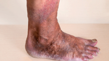 Hypostatiskt/venöst eksem på underben och fot med rodander och brun pigmentering