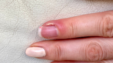 Rodnad och svullnad p åhuden vid nagel orsakat av nagelbandsinflammation/paronyki