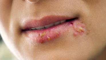 Rodnad och krustor vid mun orsakat av herpes simplex