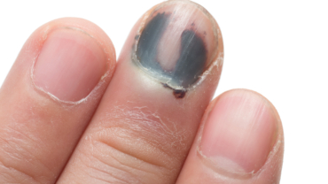 Mörkblå inlagring av blod under nagel orsakat av subungual hematom