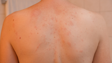 Rodnader på rygg inklusive primärmedaljong orsakat av pityriasis rosea eller medaljongsjukan.