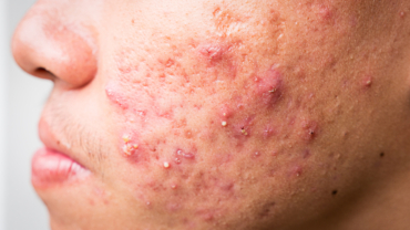 Inflammatorisk och nodulocystisk djup acne samt hypotrofa ärr på kind