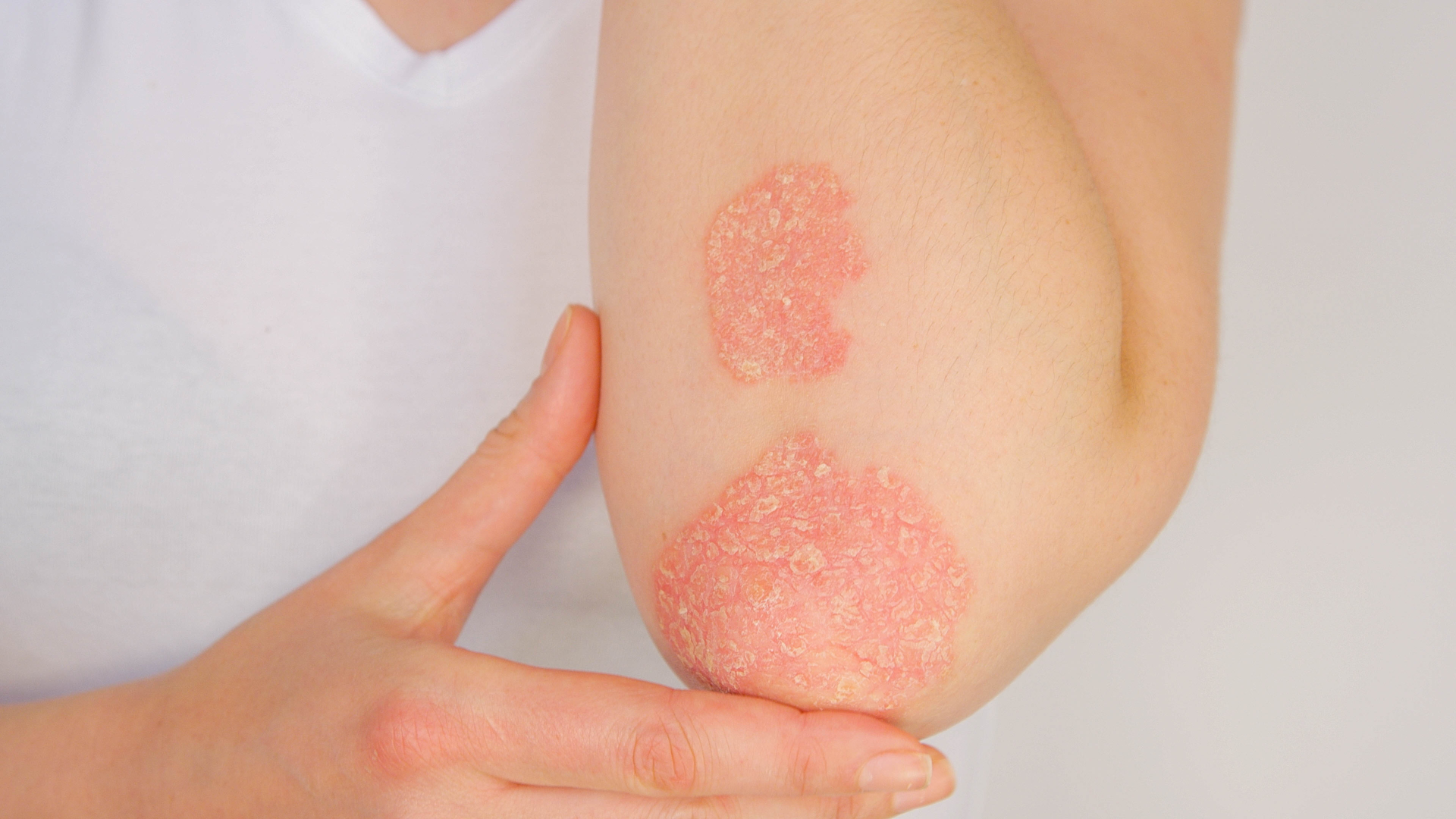 Underhållsbehandling effektivt vid lindrig psoriasis