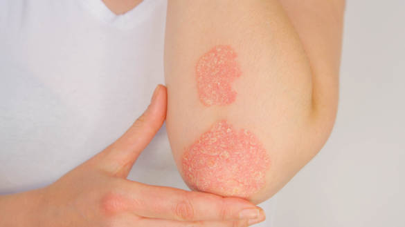 Underhållsbehandling effektivt vid lindrig psoriasis
