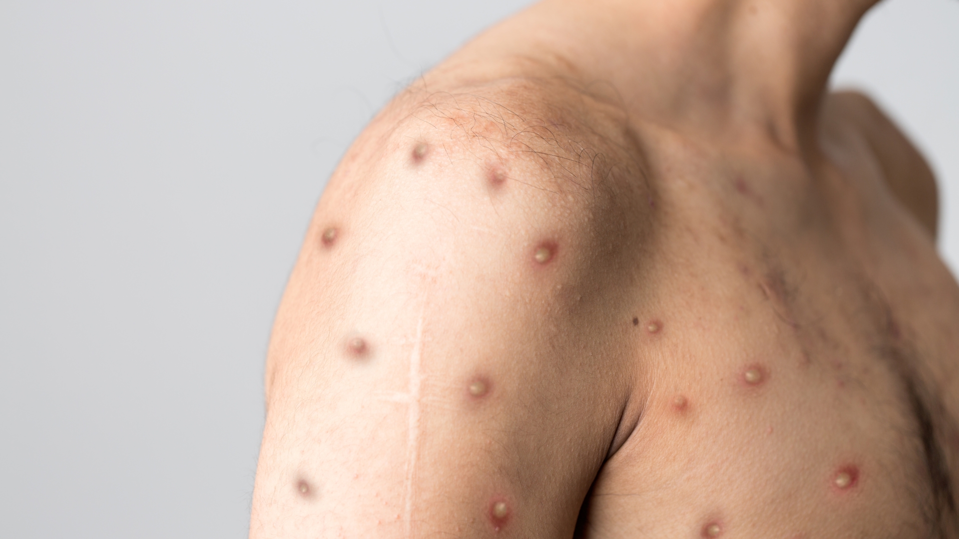 Klartecken för vaccin mot apkoppor