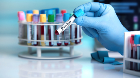 Vad är organiserad prostatacancertestning?