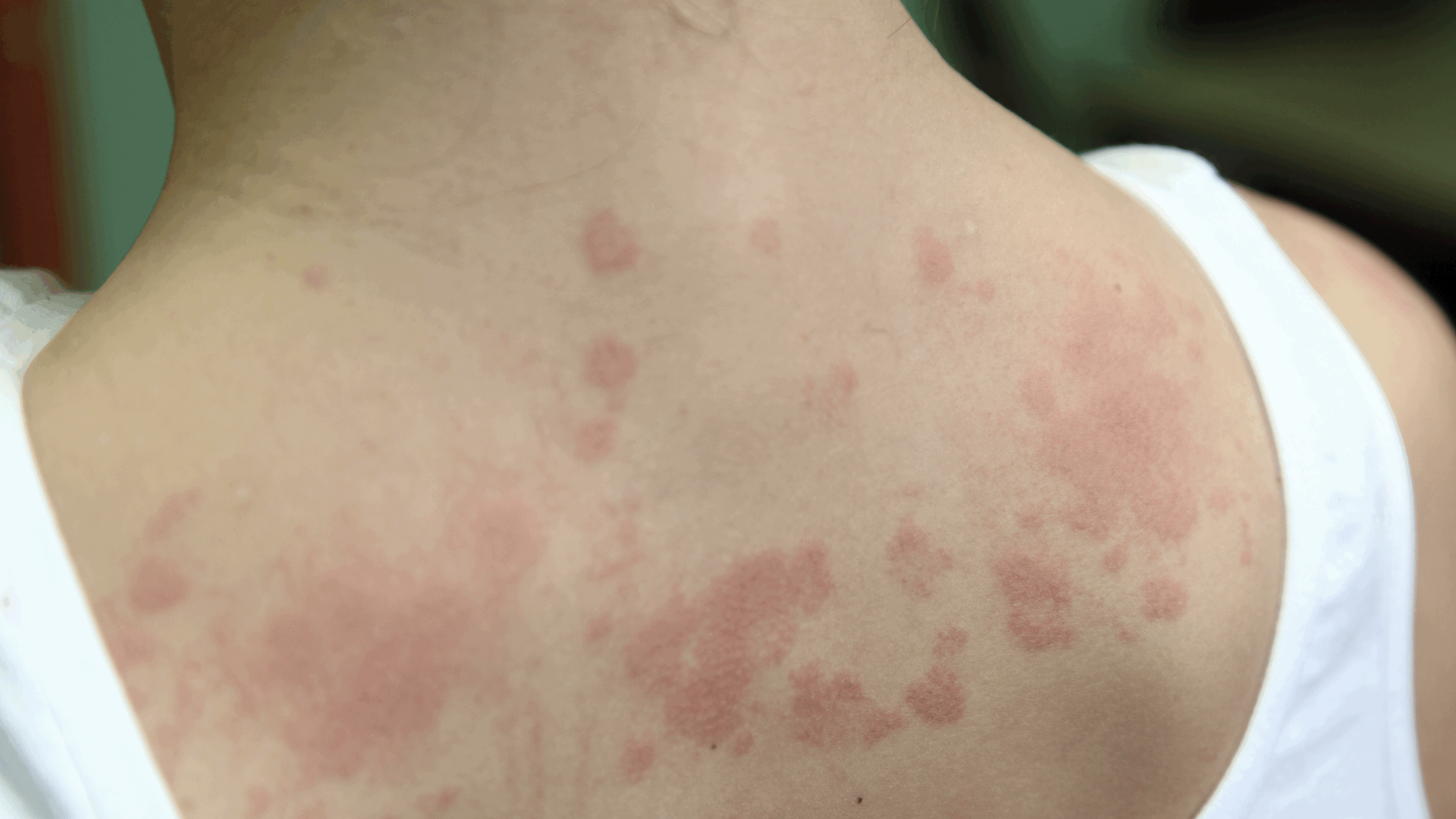 Nya behandlingar förhöjer livskvalitén för patienter med atopisk dermatit