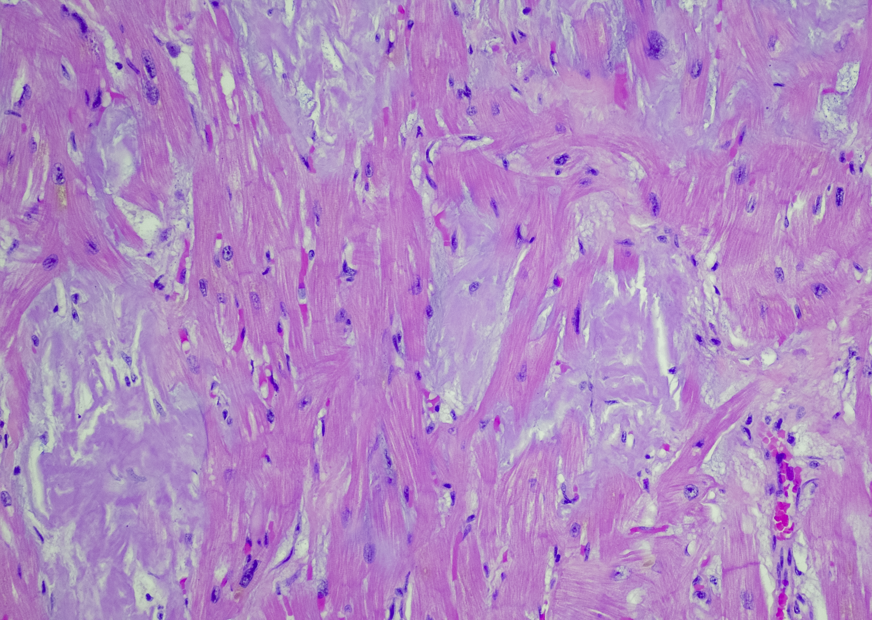 Hjärtamyloidos: microlearing