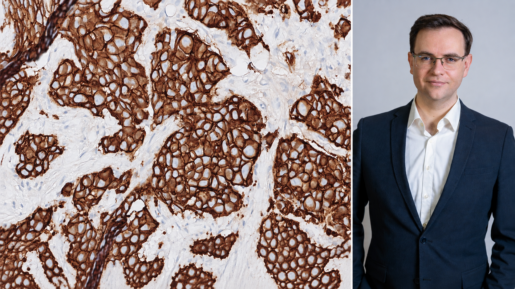 HER2-analyserna utvecklas och får nya riktlinjer