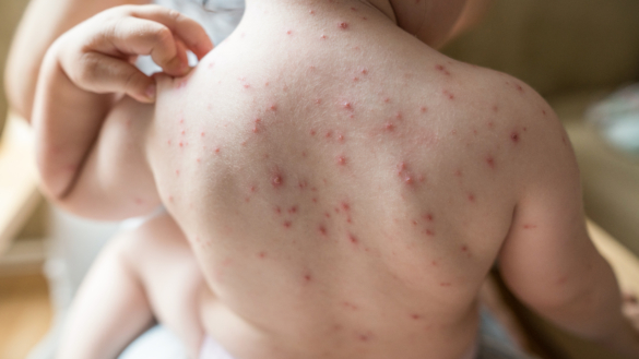Vattkoppor och RS-virus blir anmälningspliktiga